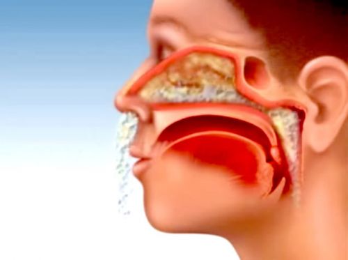 Thảo dược trị viêm xoang mạn tính