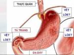 Biểu hiện của ung thư dạ dày