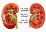 Bài thuốc thảo dược trị sỏi thận