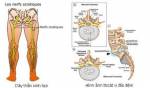 Đông y trị đau thần kinh tọa